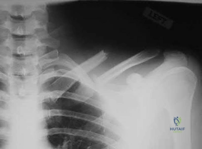 Illustration 138 for OrthoCash: Trauma MCQs & Cases for a yearold woman