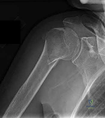 Illustration 196 for OrthoCash: Trauma MCQs & Cases for a yearold woman