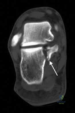 Illustration 100 for OrthoCash: Trauma MCQs & Cases for a yearold woman