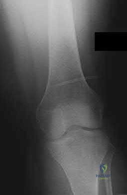 Illustration 164 for OrthoCash: Trauma MCQs & Cases for a yearold woman