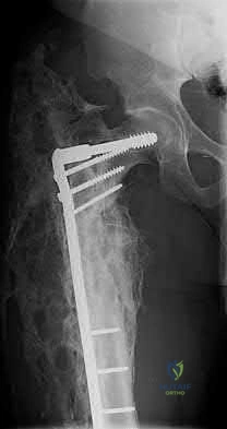Illustration 202 for OrthoCash: Trauma MCQs & Cases for a yearold woman