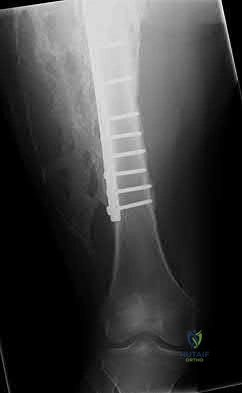 Illustration 203 for OrthoCash: Trauma MCQs & Cases for a yearold woman