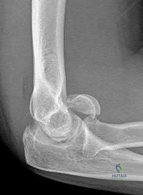 Illustration 83 for OrthoCash: Trauma MCQs & Cases for a yearold woman