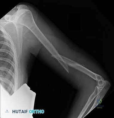 Illustration 179 for OrthoCash: Trauma MCQs & Cases for a yearold woman