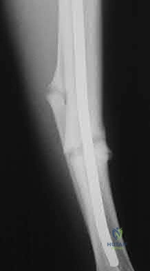 Illustration 141 for OrthoCash: Trauma MCQs & Cases for a yearold woman