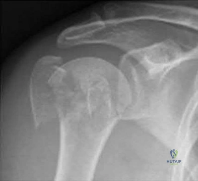 Illustration 74 for OrthoCash: Trauma MCQs & Cases for a yearold woman