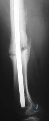 Illustration 125 for OrthoCash: Trauma MCQs & Cases for a yearold woman
