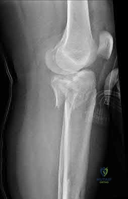 Illustration 152 for OrthoCash: Trauma MCQs & Cases for a yearold woman