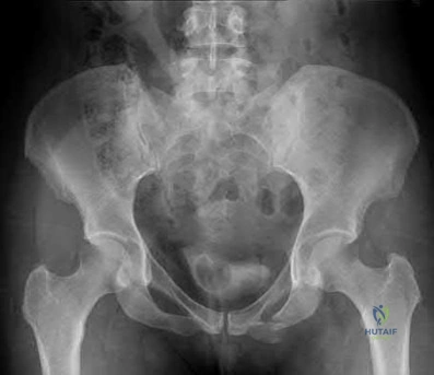 Illustration 191 for OrthoCash: Trauma MCQs & Cases for a yearold woman