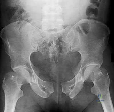 Illustration 70 for OrthoCash: Trauma MCQs & Cases for a yearold woman