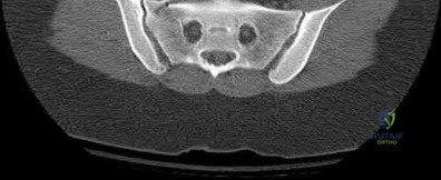 Illustration 188 for OrthoCash: Trauma MCQs & Cases for a yearold woman