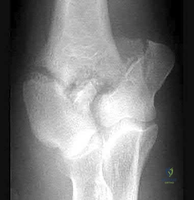 Illustration 85 for OrthoCash: Trauma MCQs & Cases for a yearold woman