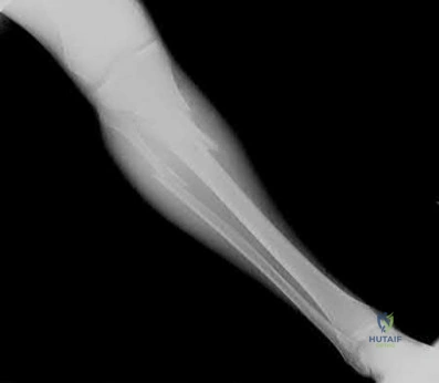 Illustration 170 for OrthoCash: Trauma MCQs & Cases for a yearold woman