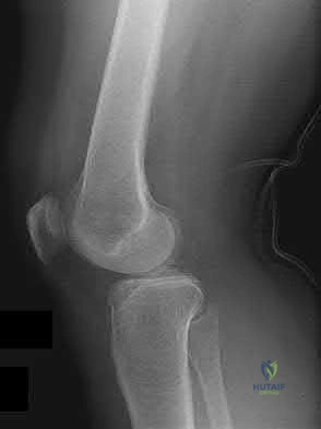 Illustration 165 for OrthoCash: Trauma MCQs & Cases for a yearold woman