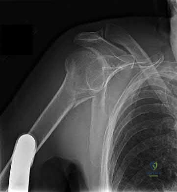 Illustration 197 for OrthoCash: Trauma MCQs & Cases for a yearold woman