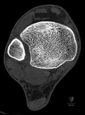 Illustration 65 for OrthoCash: Trauma MCQs & Cases for a yearold woman
