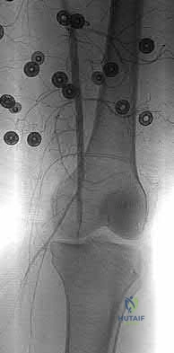 Illustration 166 for OrthoCash: Trauma MCQs & Cases for a yearold woman