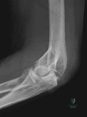 Illustration 73 for OrthoCash: Trauma MCQs & Cases for a yearold woman