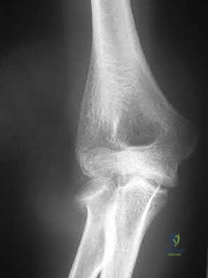 Illustration 200 for OrthoCash: Trauma MCQs & Cases for a yearold woman