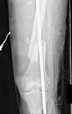 Illustration 130 for OrthoCash: Trauma MCQs & Cases for a yearold woman