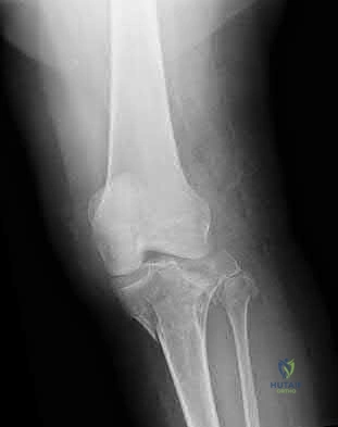 Illustration 151 for OrthoCash: Trauma MCQs & Cases for a yearold woman