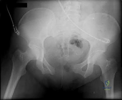Illustration 126 for OrthoCash: Trauma MCQs & Cases for a yearold woman