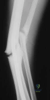 Illustration 140 for OrthoCash: Trauma MCQs & Cases for a yearold woman
