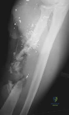 Illustration 22 for OrthoCash: Trauma MCQs & Cases for a yearold woman