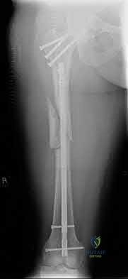 Illustration 113 for OrthoCash: Trauma MCQs & Cases for a yearold woman