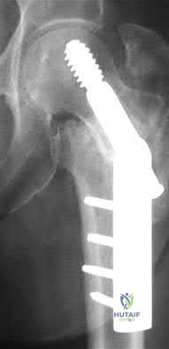 Illustration 50 for OrthoCash: Trauma MCQs & Cases for a yearold woman