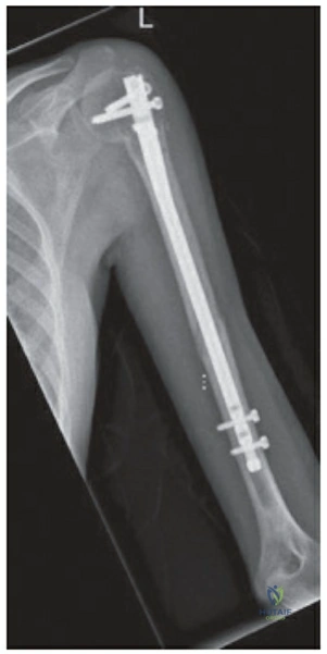 X-ray image of humeral shaft fracture