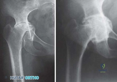Orthopedic Prometric MCQs - Chapter 3 Part 30