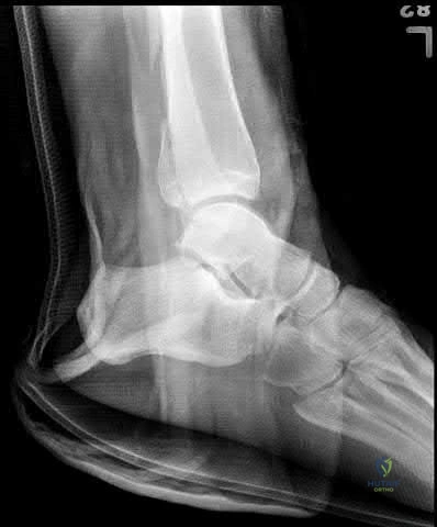 Orthopedic Prometric MCQs - Chapter 4 Part 3