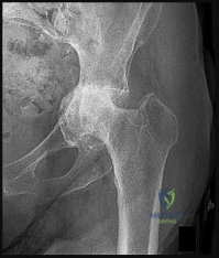Illustration of unicondylar knee arthroplasty uka - Dr. Mohammed Hutaif