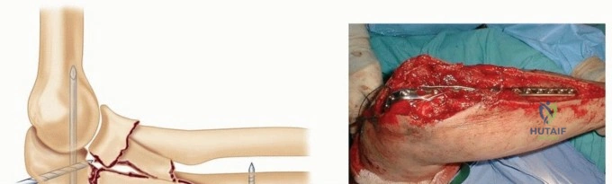 Peripheral Nerve Injuries: Comprehensive Anatomy, Pathophysiology, and Surgical Management