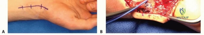 Peripheral Nerve Injury Classification and Operative Management