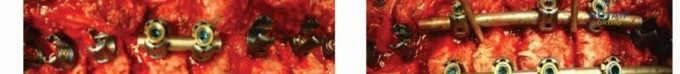 Peripheral Nerve Surgery: Instrumentation, Preparation, and Techniques for Neurorrhaphy