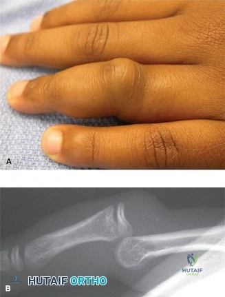 Illustration of dislocation of the pip - Dr. Mohammed Hutaif