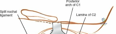 Illustration of c vertebral space - Dr. Mohammed Hutaif