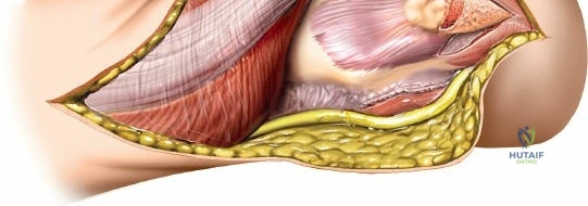 Illustration of elbow without olecranon - Dr. Mohammed Hutaif