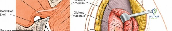 Illustration of approach to the sacroiliac - Dr. Mohammed Hutaif