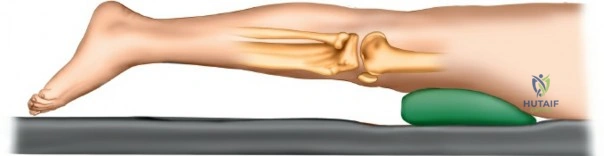 Illustration 1 for Navigating the Posterior Tibial Plateau: Semitendinosus Tendon Plane