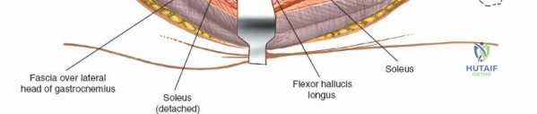 The Posterolateral Approach to the Tibia: Indications, Surgical Anatomy, and Technique Overview