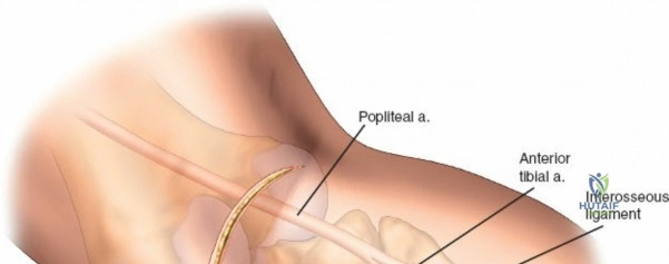 Figure 5: Pre-operative CT scan with 3D reconstruction showing a posterolateral tibial plateau fracture.