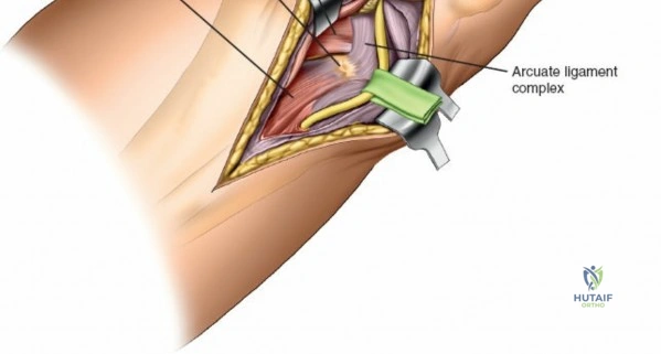 Figure 11: Deep dissection exposing the soleus muscle and its separation from the gastrocnemius.