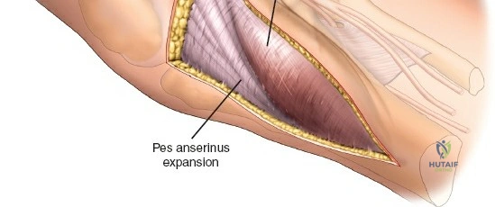 Figure 13: Elevation of depressed articular fragments and bone graft placement in the metaphyseal void.