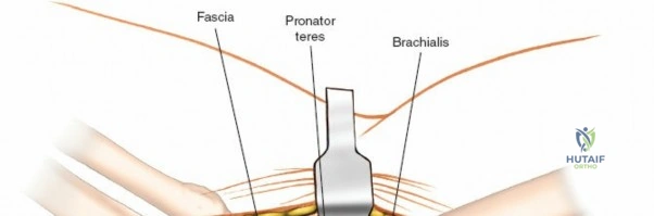 Unlocking the Coronoid: Posteromedial Approach to the Process of the Ulna