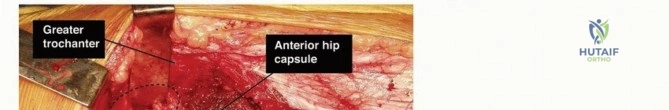 Primary and Delayed Primary Peripheral Nerve Repair: Principles, Biomechanics, and Microsurgical Techniques