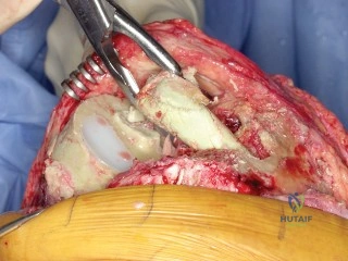 For Doctors Proximal Humeral Fractures, Extra AArticular 2-Part, Surgical Neck, Impaction Treatment Nailing (Straight Nail)