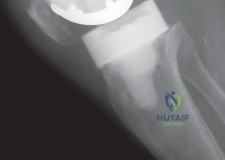 Arab Ortho Board MCQs - Part 22